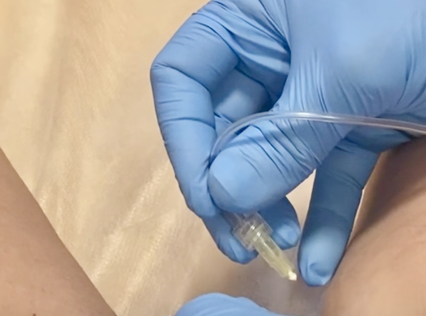 KARBOKSYTERAPIA MEDIKA